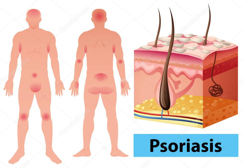 Diagram showing psoriasis in human