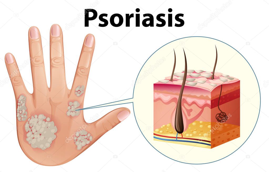 Diagram showing psoriasis on human hand