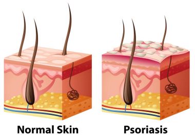 Human skin diagram with normal and psoriasis clipart