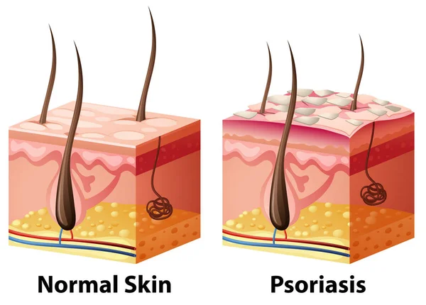 Diagramme de la peau humaine avec normale et psoriasis — Image vectorielle