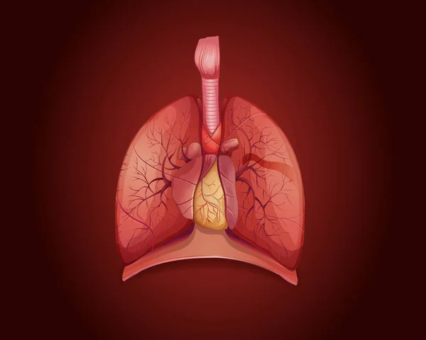 Diagram showing lungs with disease — Stock Vector