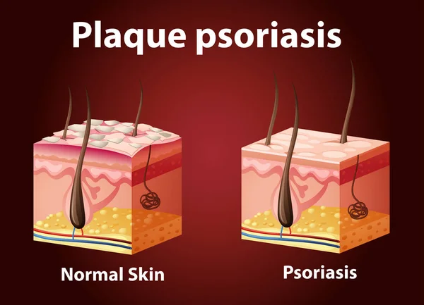 Diagramme montrant le psoriasis en plaques — Image vectorielle