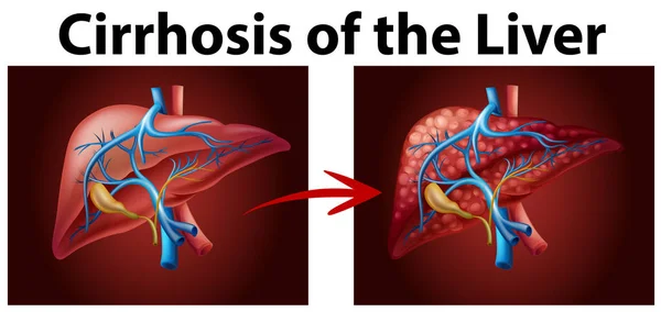 Diagrama que muestra cirrosis del hígado — Archivo Imágenes Vectoriales