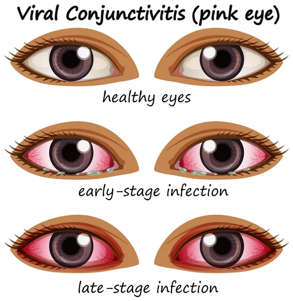 Viral ögonkonjunktivit i människors ögon — Stock vektor