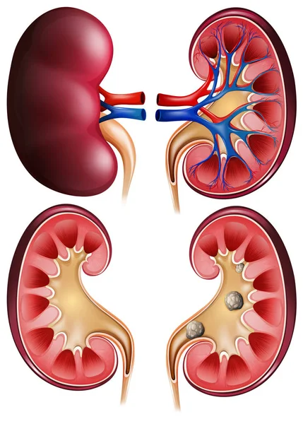 Nieren und Nierensteine auf Plakat — Stockvektor
