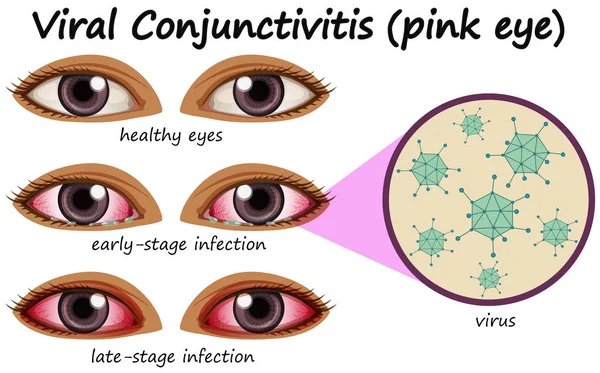 Menselijke oogziekte met virale conjunctivitis — Stockvector