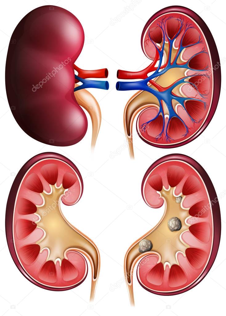 Kidneys and kidney stones on poster