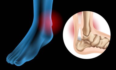 Kronik Aşil tendon gözyaşı gösteren diyagram
