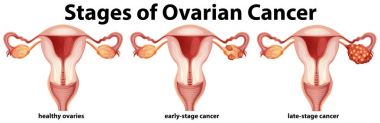 Diagram showing stages of ovarian cancer clipart