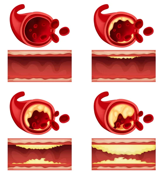 Schema che mostra coagulo di sangue — Vettoriale Stock