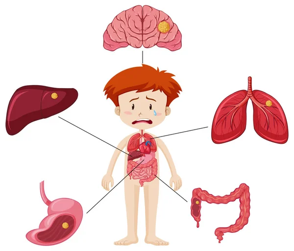 Jongen en diagram waarop verschillende delen van organen met ziekte — Stockvector