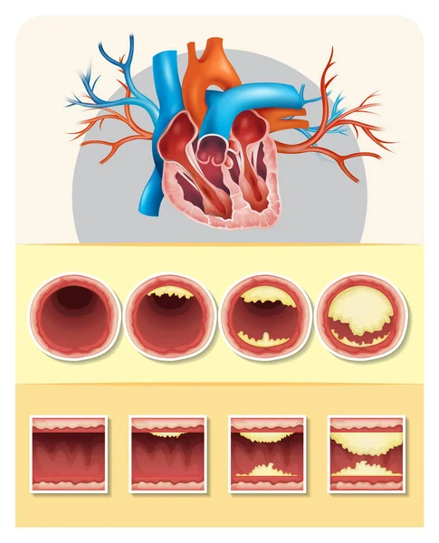 Schema che mostra il grasso nel cuore umano — Vettoriale Stock