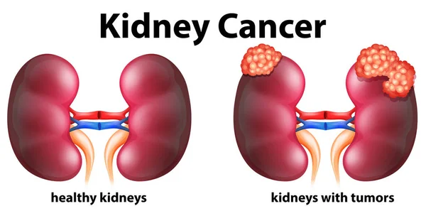 Diagramme montrant le cancer du rein chez l'homme — Image vectorielle