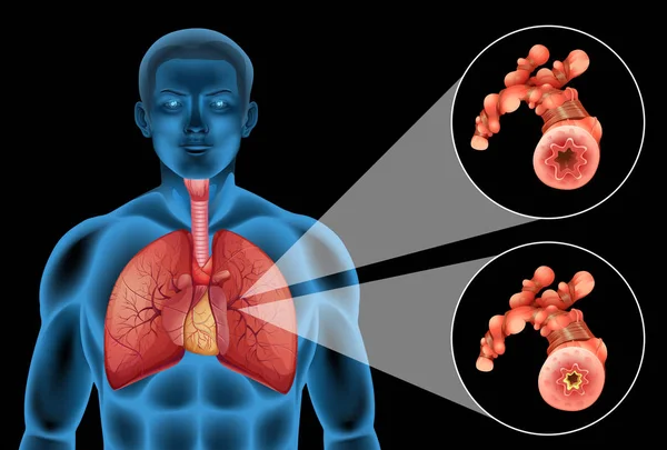 Diagrama mostrando pulmões humanos e doença — Vetor de Stock