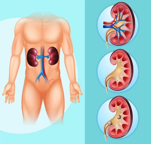 Piedras humanas y renales — Vector de stock