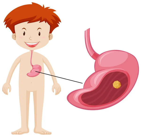 Human boy with stone in stomach — Stock Vector