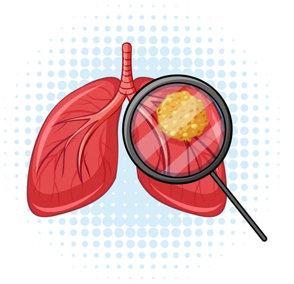 Kanker in de menselijke longen — Stockvector