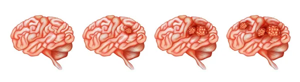 Verschiedene Stadien von Krebs im Gehirn — Stockvektor