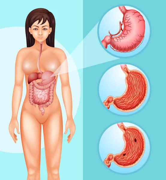 Diagramma che mostra donna e cancro allo stomaco — Vettoriale Stock