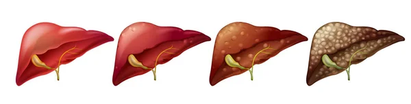 Verschiedene Stadien der menschlichen Leber — Stockvektor