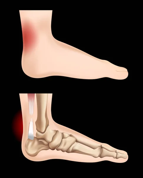 Diagram showing tendon injury — Stock Vector