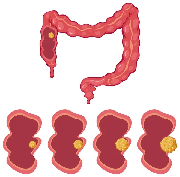 Processo di colon e cancro — Vettoriale Stock