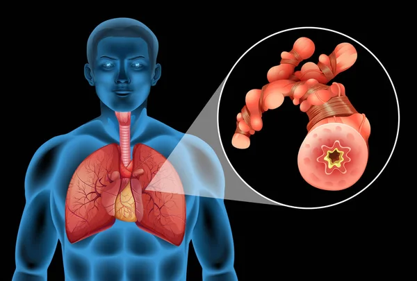 Hombre humano con tumor en los pulmones — Vector de stock