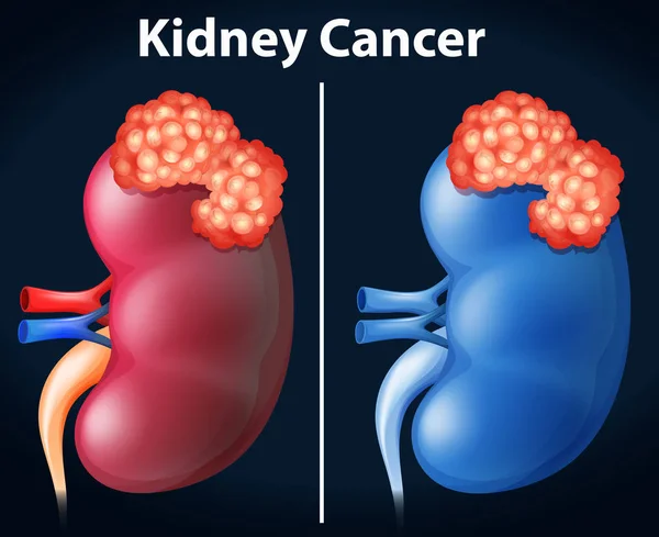 Dos diagramas de cáncer de riñón — Archivo Imágenes Vectoriales