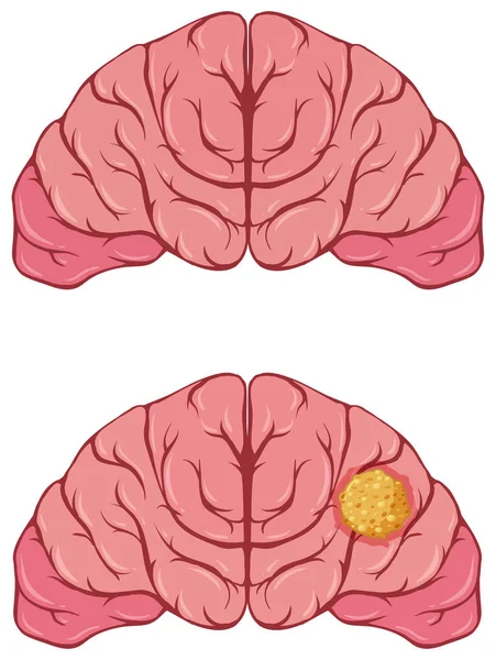 Human brain with cancer — Stock Vector