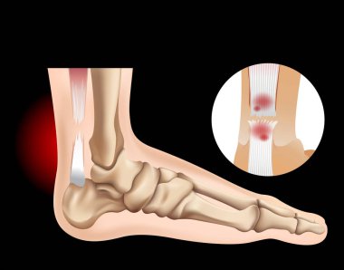 Gözyaşı tendon ile insan ayağı