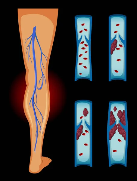 Coágulo de sangue na perna humana — Vetor de Stock
