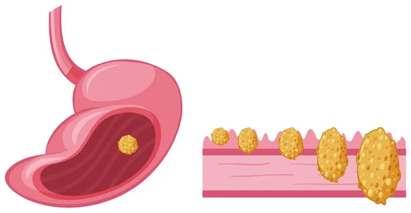 Cancro no estômago humano —  Vetores de Stock