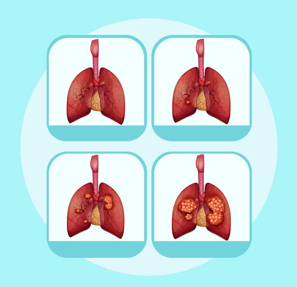 Diagram showing lung cancer stages — Stock Vector