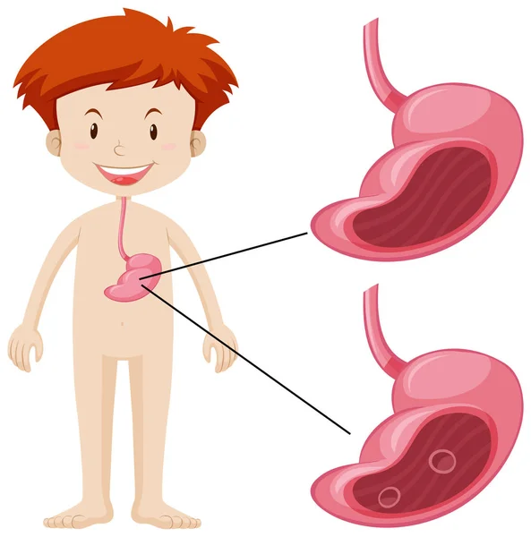 Little boy and unhealthy stomach — Stock Vector