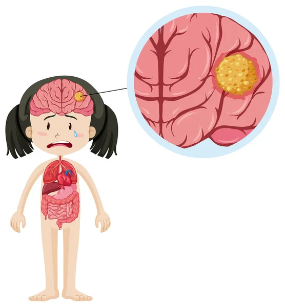 Petite fille et cancer du cerveau — Image vectorielle
