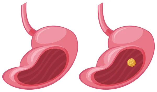 Estómago humano y cáncer — Vector de stock