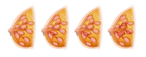 Diagramme montrant le cancer du sein chez l'homme — Image vectorielle