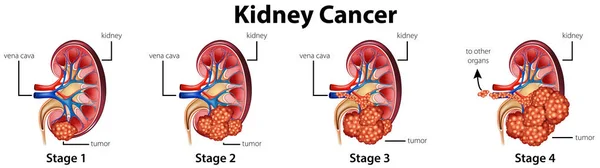 Diagram showing different stages of kidney cancer — Stock Vector