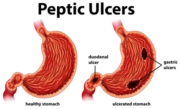 Diagrama mostrando úlceras pépticas — Vetor de Stock