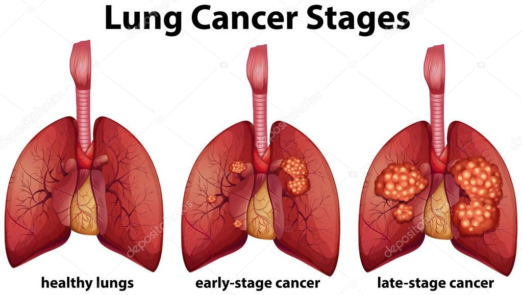 Diagram Showing Lung Cancer Stages  U2014 Stock Vector
