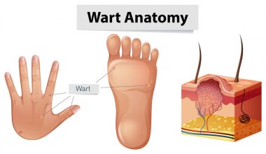 İnsan anatomisi siğil el ve ayak