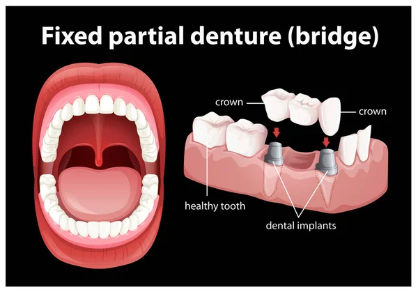 Lékařské vektor pevné Částečná zubní protéza — Stockový vektor