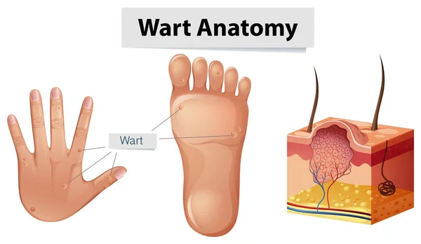 Wart anatomia humana na mão e pé — Vetor de Stock