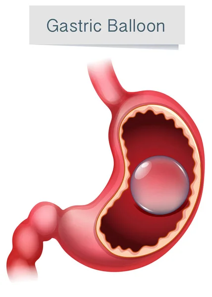 Illustrazione del palloncino gastrico di anatomia umana — Vettoriale Stock