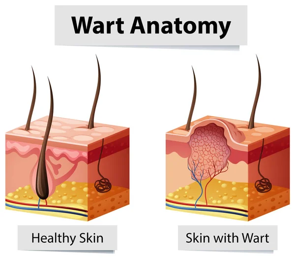 Wart Ilustração da anatomia da pele humana —  Vetores de Stock