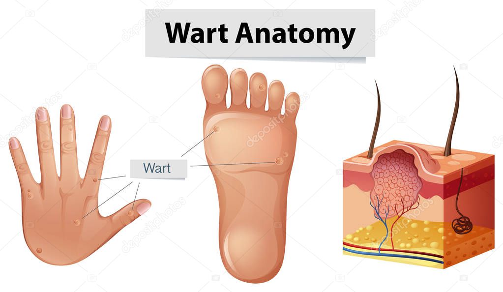 Human Anatomy Wart on Hand and Foot
