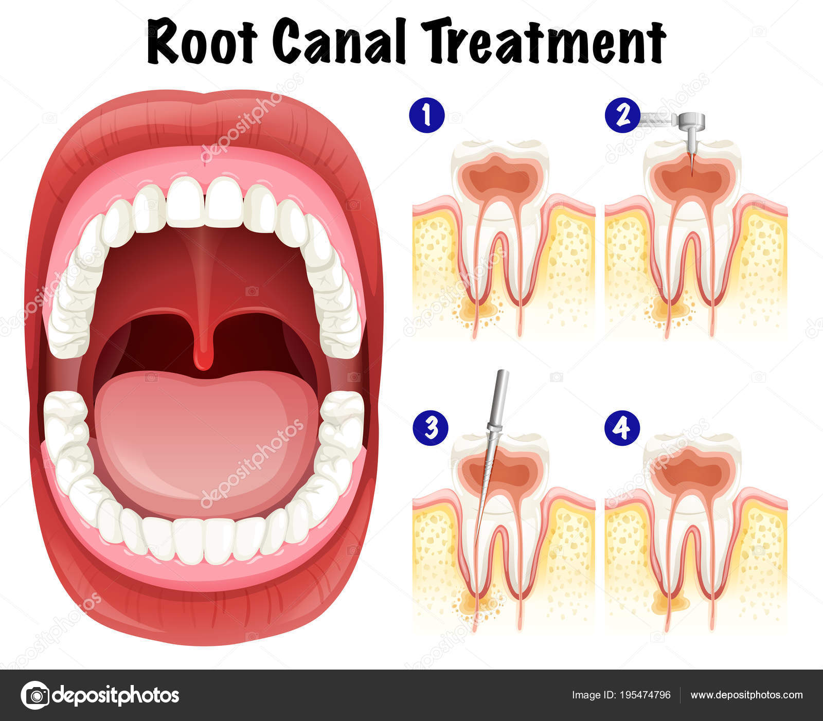 Root canal Vector Art Stock Images | Depositphotos Root canal Vector Art Stock Images | Depositphotos