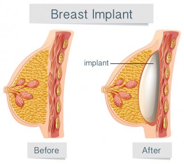 Meme implantı insan anatomisi