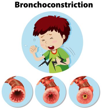 Human Anatomy Bronchoconstriction on White Background clipart