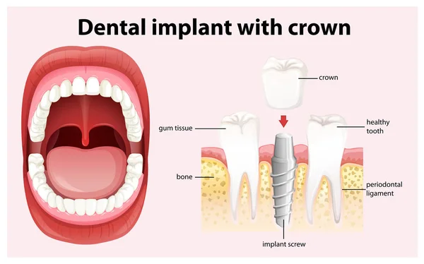 Dental Implant with Crown Vector — Stock Vector